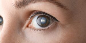 Understanding the Impact of Cataracts and Night Vision